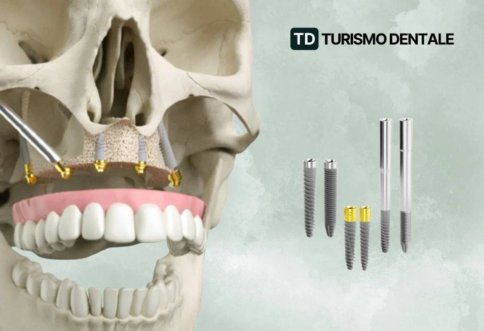 Impianti inclinati Atrofia Ossea