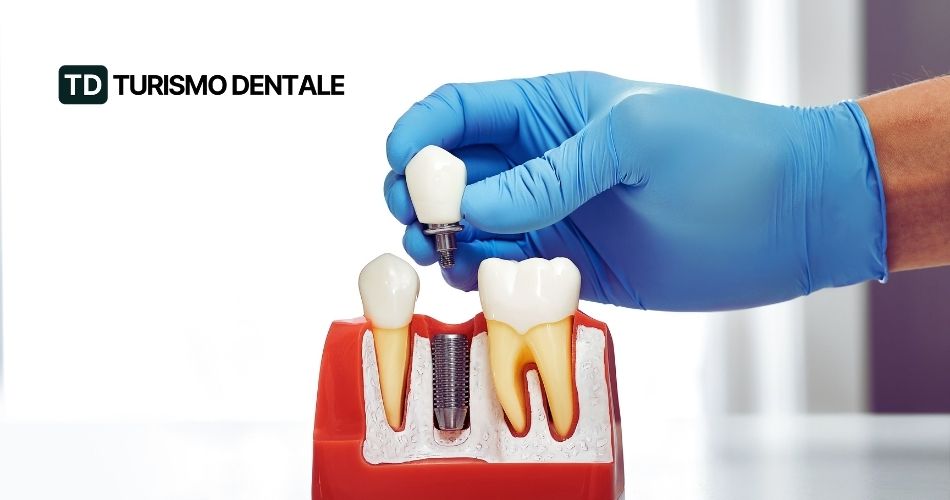 Implantologia dentale
